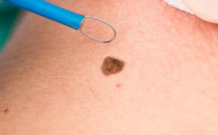 你身上有色素痣吗,你身上的痣有什么含义图片