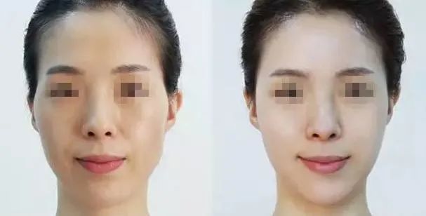 颧骨突出打瘦脸针有用吗,颧骨肉多可以打瘦脸针吗