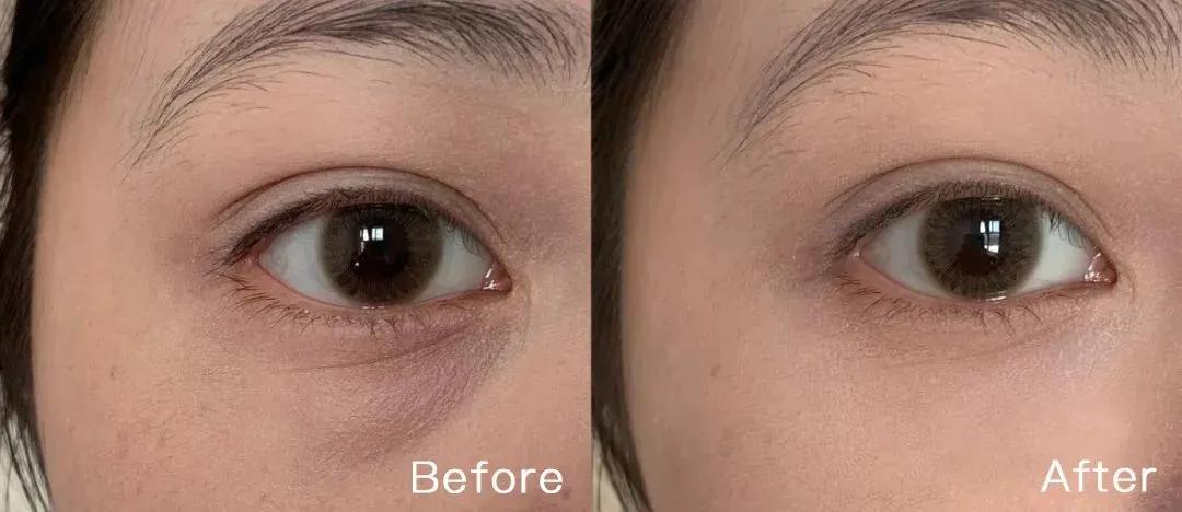 真牛！松弛老态的眼周，都被“马应龙”治住了