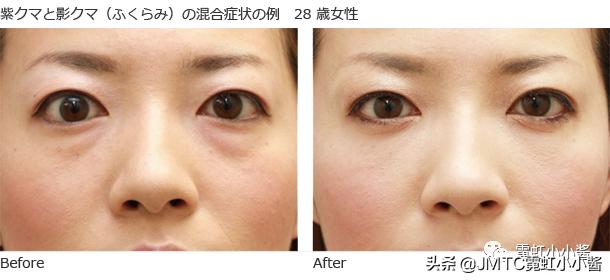 25岁抗老拯救垮脸,哪种脸型抗衰抗皱