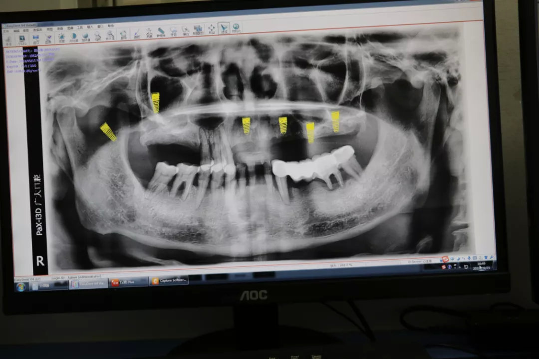 老人家种牙去哪里最好,50岁种牙最好方法怎么种