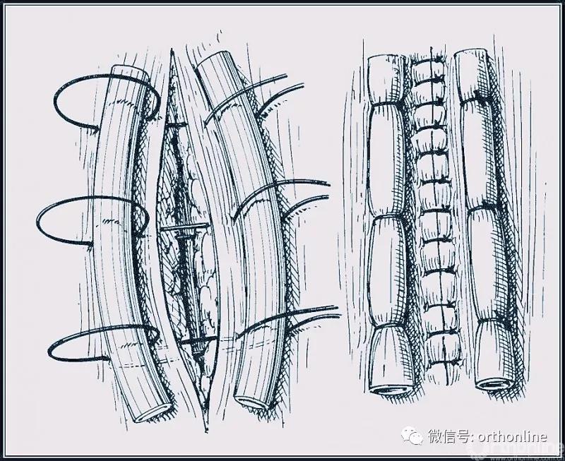 常用的手术缝合方法图,临床常见常用伤口缝合方法