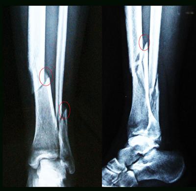骨折和骨裂哪一个更严重,骨折与骨裂哪个严重