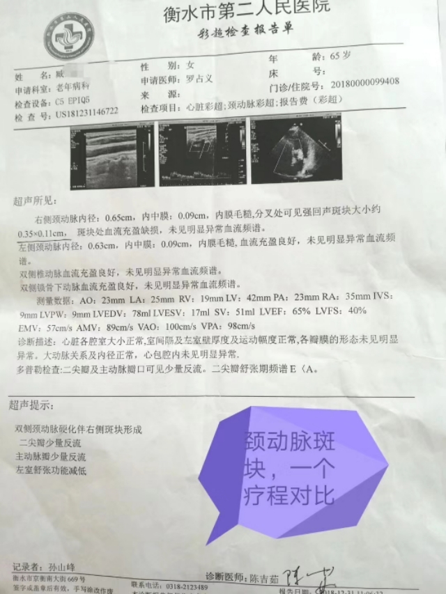 消斑散结治血管斑块中药,消斑溶栓通脉汤处方