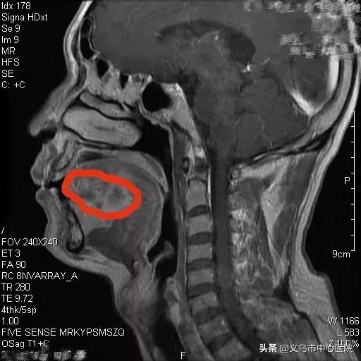 远离舌尖上的致癌物,远离槟榔癌症