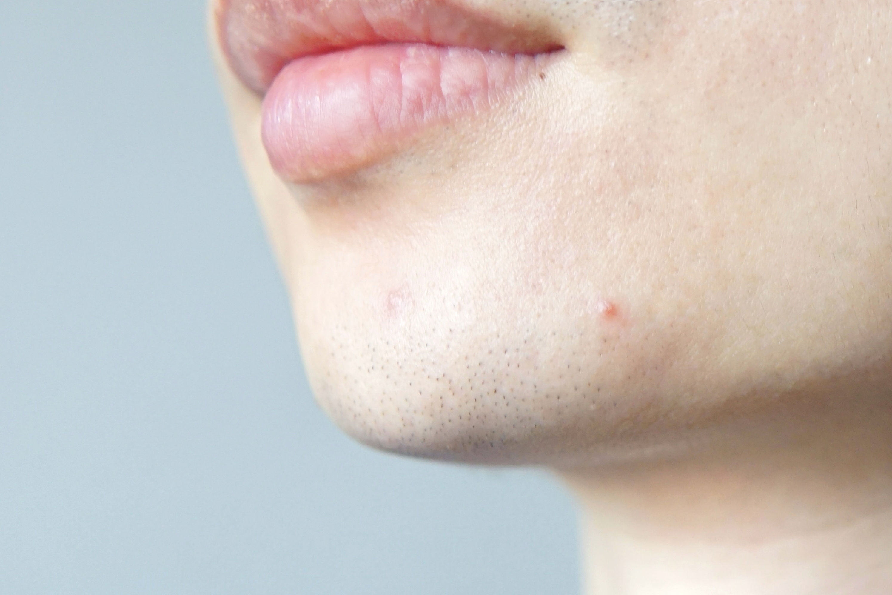 夏日科学战痘攻略,全套战痘攻略