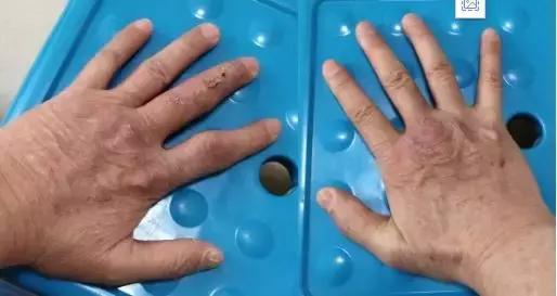 痛风脚踝有痛风石怎样才能变小,痛风石是引起痛风的根本原因吗