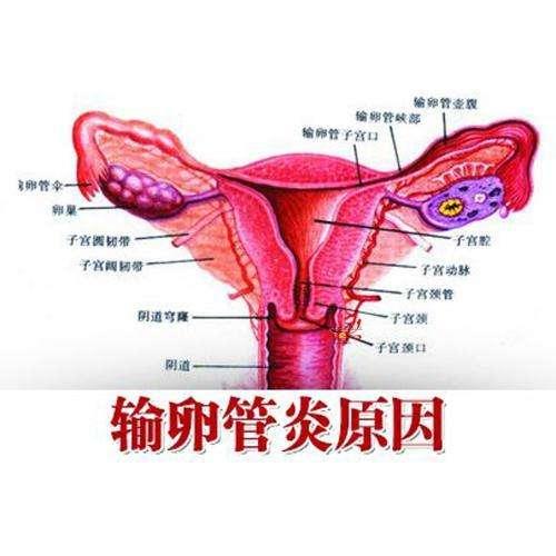 输卵管炎症一定要重视,输卵管炎症不用手术怎么治疗