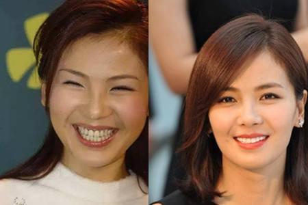 刘涛同款烤瓷牙,刘涛的牙齿烤瓷牙和全瓷牙