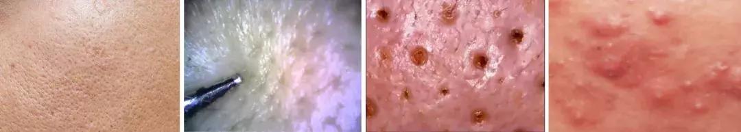 怎样改善油性皮肤问题,怎样改善油性皮肤长痘