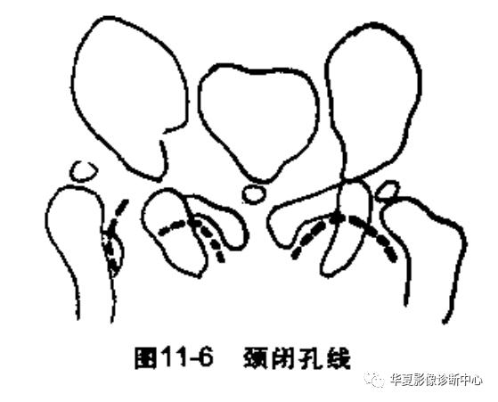 先天性髋关节脱位截骨术全过程,先天性髋关节脱位可以考驾驶证吗