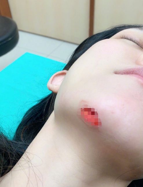 范玮琪摔跤反被疑怀孕，下巴皮开肉绽缝15针，还被骂炒作现世报