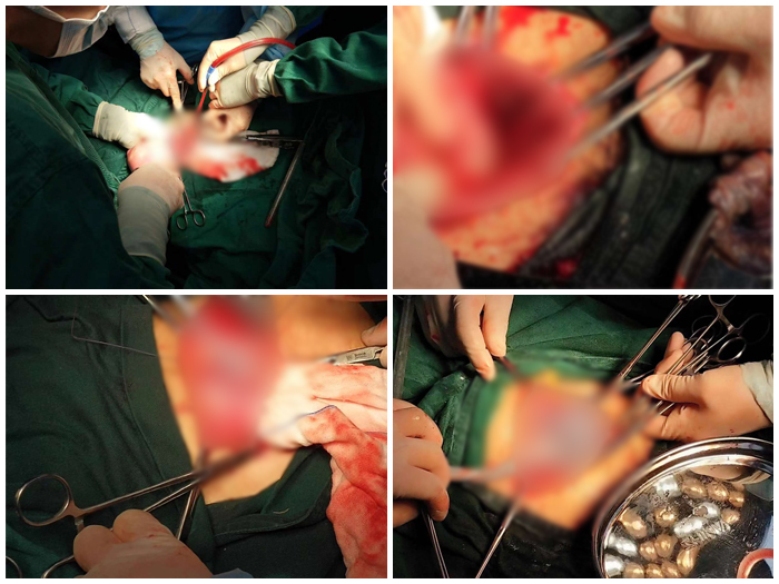 河南沈丘妇幼孕妇大出血,河南一名孕妇大出血