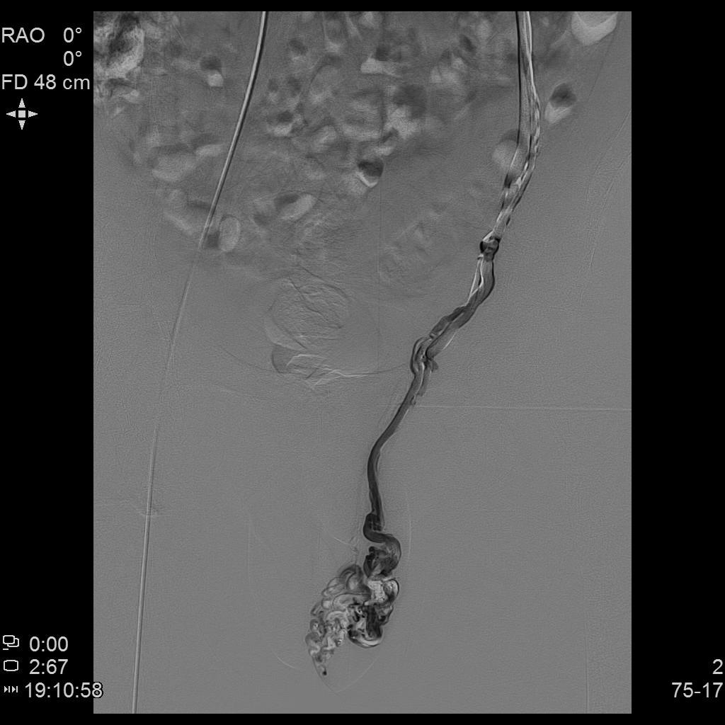 精索静脉曲张介入栓塞死路一条,精索曲张介入栓塞