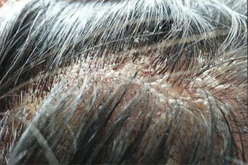 清洗头皮毛囊会长头发么,头皮毛囊清理洗头方法