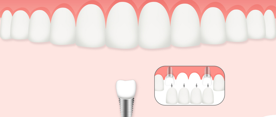 一个月工资种牙,一年工资不够种牙