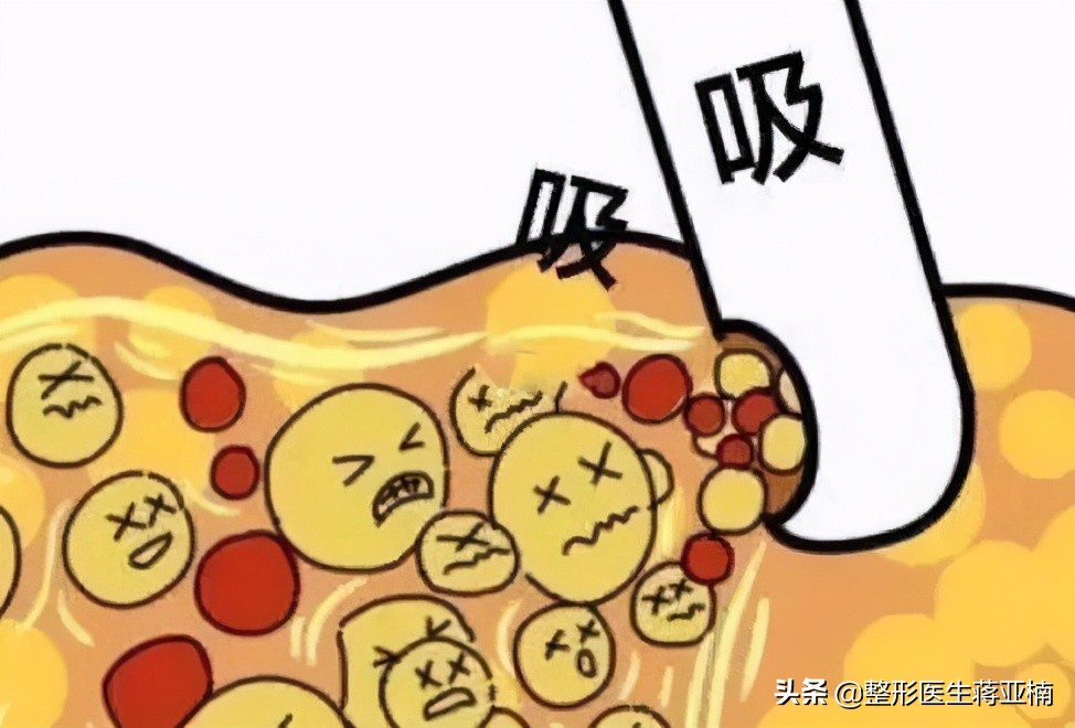 苹果肌吸脂抽出来的是血水,下额吸脂吸出来的都是血水