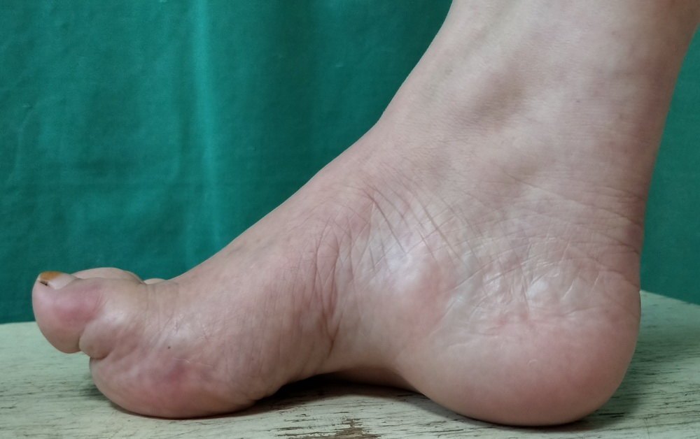 足内翻导致足弓疼,足内翻会导致什么腿型怎么改