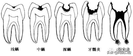 牙齿从中间蛀掉如何治疗,牙齿蛀了怎么办