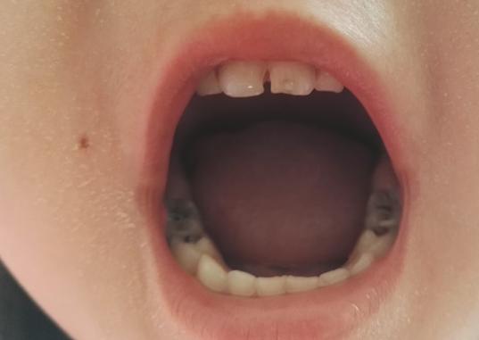 孩子龋齿牙疼需要治疗么,小孩龋齿牙疼的厉害怎么办