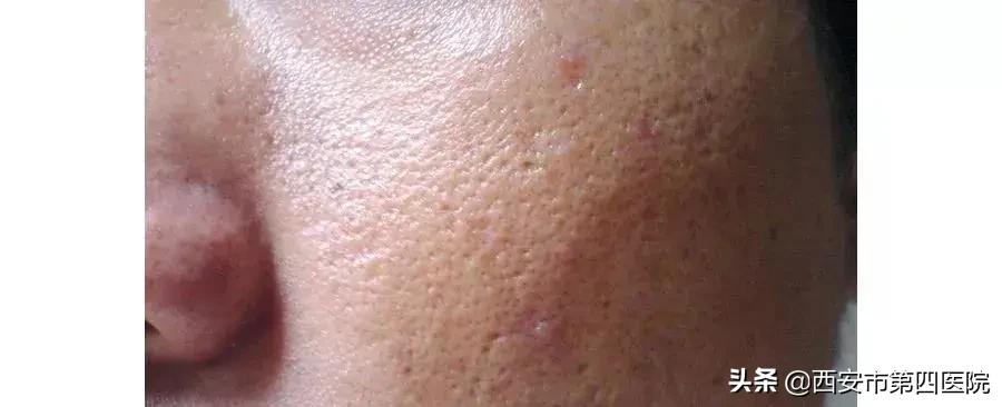 毛孔粗大的正确护肤方法,毛孔粗大正确护肤方法