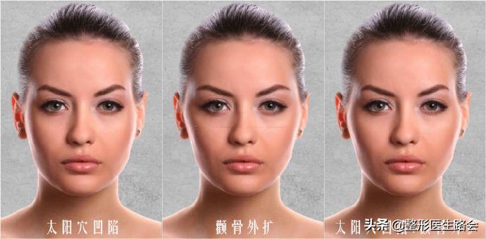 脸大颧骨高除了磨骨还有什么方法,颧骨高是选择磨骨还是填充鼻基底