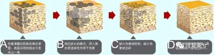 便宜的1000多，贵的10000起步，祛斑套餐的差距咋这么大？