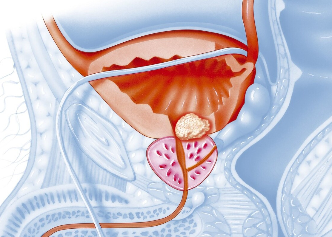 有hpv感染最怕做这几件事,身体发出4个信号证明你感染了hpv