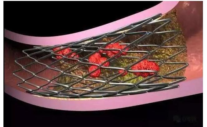 心脏介入支架后再狭窄如何处理,冠脉介入后再狭窄怎么办