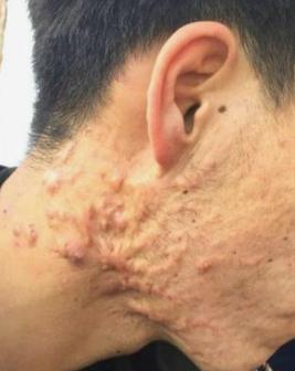 原来疤痕处感染化脓了怎么处理,刚刚形成的疤痕疙瘩怎么治疗