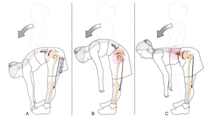 顽固性腰痛怎么治愈,困扰多年的腰疼问题终于搞清楚了