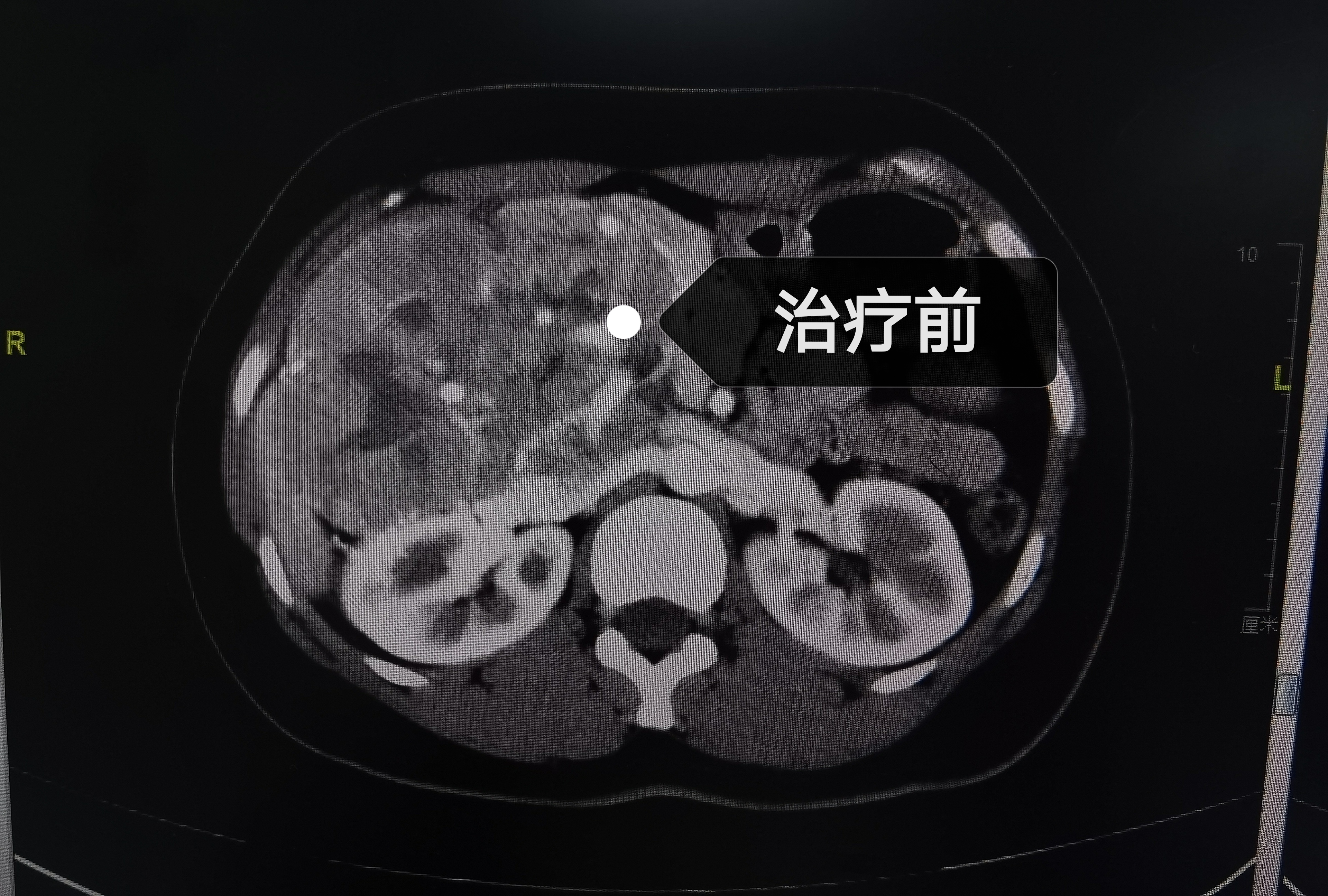 泌尿肿瘤mdt是什么意思,泌尿系肿瘤mdt专家共识
