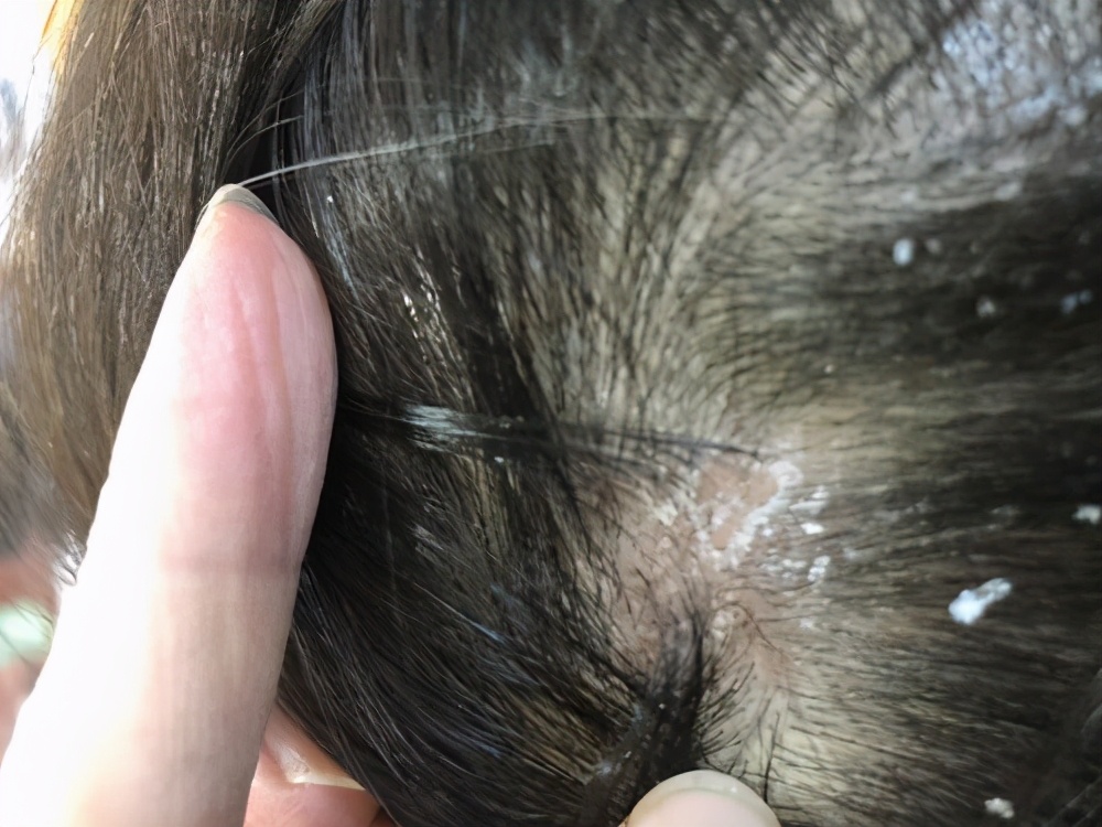 头上密密麻麻小疙瘩是什么,头上摸到肿块是怎么回事