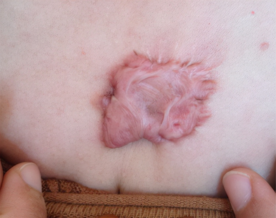 疤痕疙瘩越长越大怎么办,胸前疤痕疙瘩怎么能彻底消除