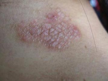 初中学生身上发痒起红疹怎么回事,24岁出现荨麻疹