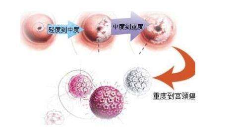 宫颈癌最新护理知识,什么是宫颈癌癌前病变注意事项
