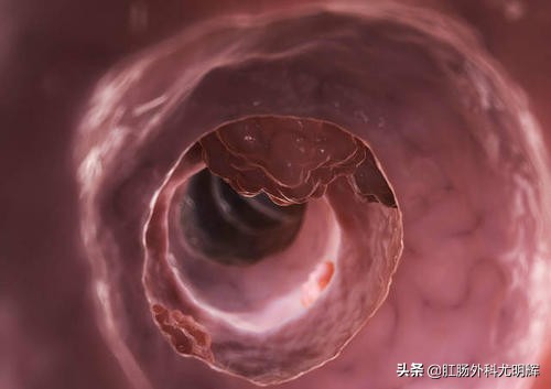 肠道息肉切除肛周坠胀吗,肠道息肉切除流血正常吗