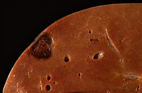 为什么肝血管瘤医生建议不用管,有了肝血管瘤要注意什么