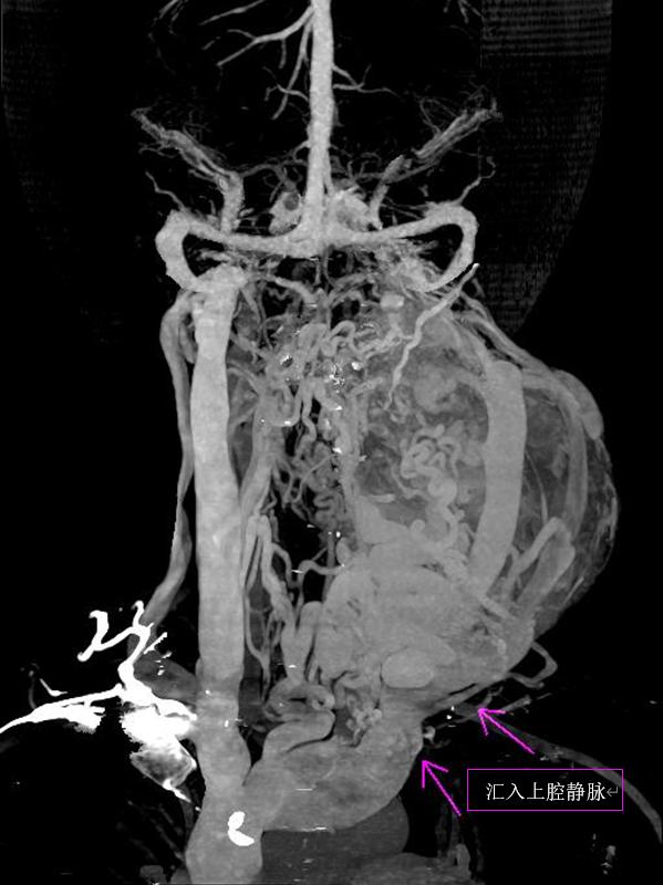 颈部肿块为什么有80%是肿瘤,颈部肿块1年没有变化
