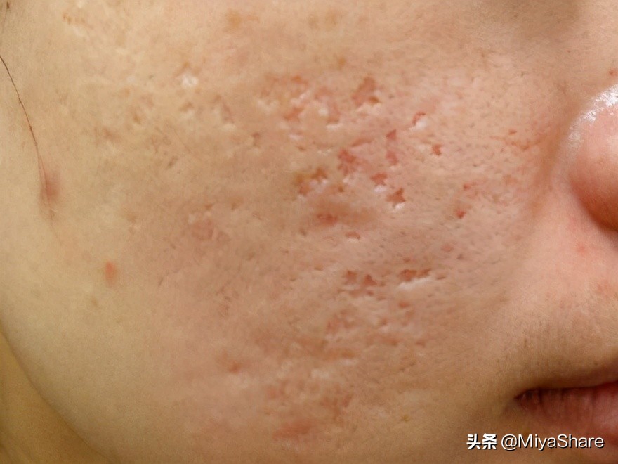 2分钟学会痘印如何快速消除,痘印怎么祛16个祛除痘印的小妙招