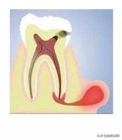 牙龈起包在家怎么办,牙龈有个脓包会传染吗