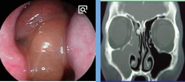 慢性鼻窦炎药物治疗原则,慢性鼻窦炎初步诊疗措施