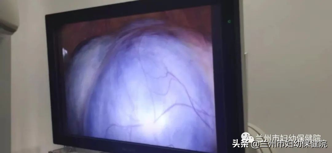 高龄盆腔肿瘤建议切除吗,腹腔镜手术卵巢肿瘤10cm