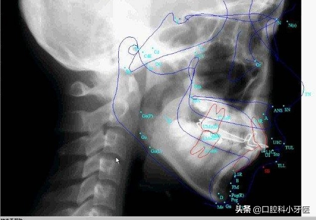 牙医的良心忠告牙齿矫正,别急着牙齿矫正先弄懂这10件事