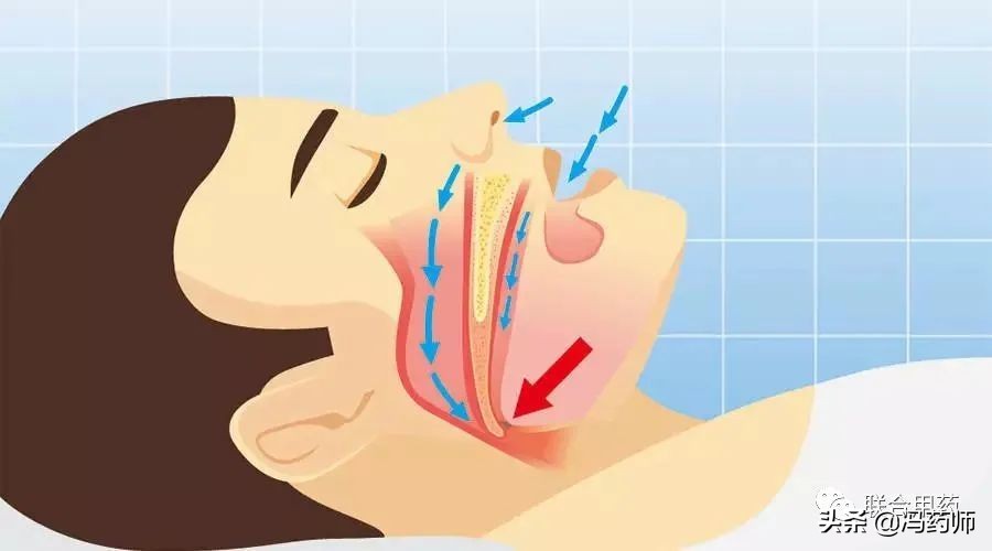 打鼾的联合用药方案,包含中药