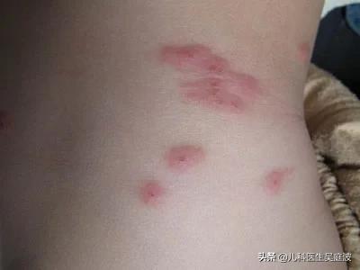 丘疹性荨麻疹是麻疹吗,丘疹性荨麻疹用了药还是痒