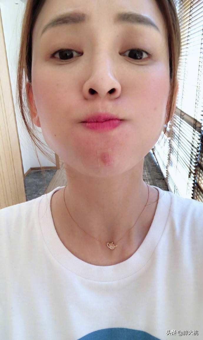 解决痘痘肌你需要知道这些,关于痘痘肌的专业知识