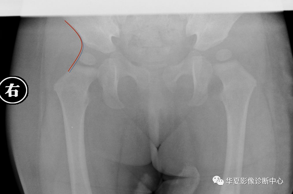 先天性髋关节脱位截骨术全过程,先天性髋关节脱位可以考驾驶证吗