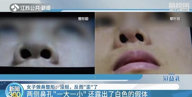 女子隆鼻拆夹板歪了,施尔美整形医院鼻综合