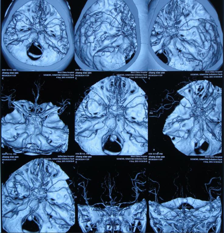 结核性脑积水,脑膜炎脑积水要治疗多久